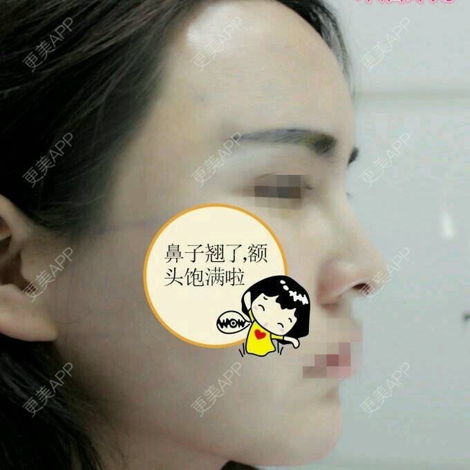 更美 - Mrs.Li👯的经验 | 郑州 | 自体脂肪填全脸 | 隆鼻修复