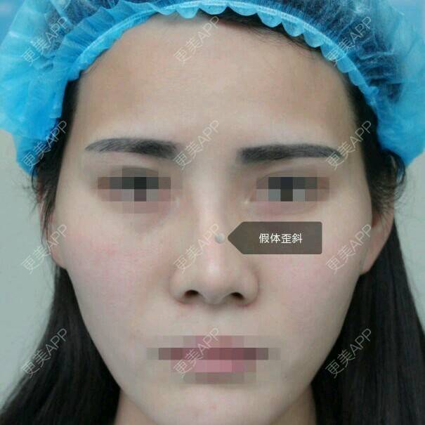 更美 - Mrs.Li👯的经验 | 郑州 | 自体脂肪填全脸 | 隆鼻修复