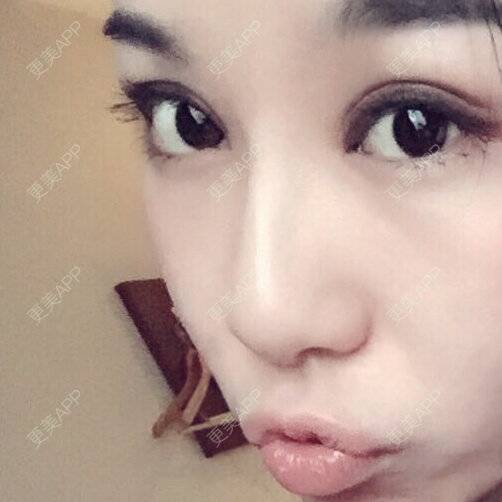 更美 - lim_g6的玻尿酸太阳穴经验 | 美购日记 | 玻尿酸太阳穴 | 上海