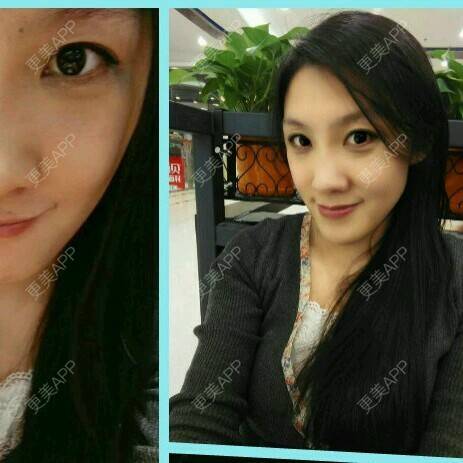 更美 - 更美用户黄小仙的玻尿酸经验 | 美购日记 | 哈尔滨