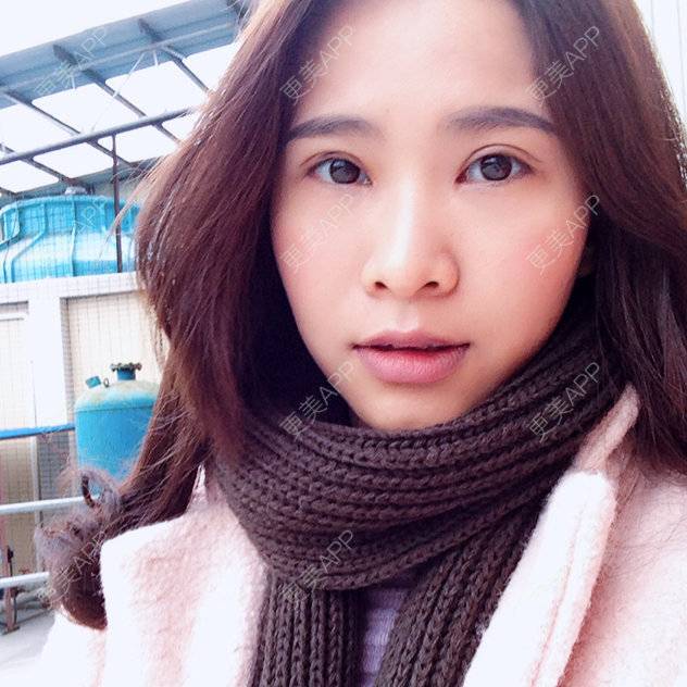 更美 - TING0的双眼皮经验 | 美购日记 | 双眼皮 | 广州