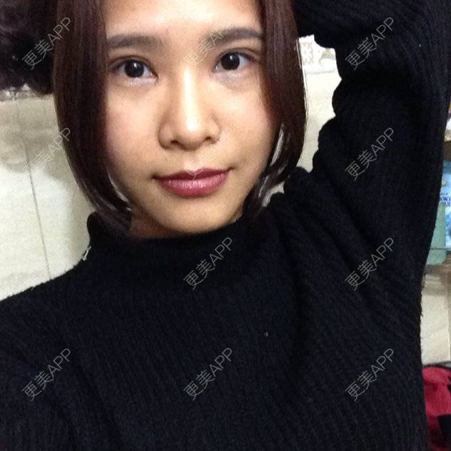 更美 - TING0的双眼皮经验 | 美购日记 | 双眼皮 | 广州