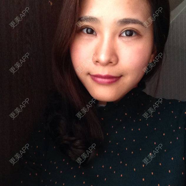 更美 - TING0的双眼皮经验 | 美购日记 | 双眼皮 | 广州