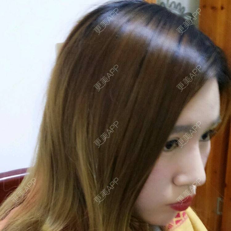 更美 - 心心念念心的经验 | 鼻翼软骨缩合 | 耳软骨 | 鼻部多项 | 美购日记 | 广州