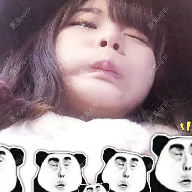 更美 - 我有一头小毛驴的自体脂肪隆鼻经验 | 西安 | 自体脂肪丰太阳穴 | 自体脂肪隆鼻 | 美购日记 | 自体脂肪垫下巴