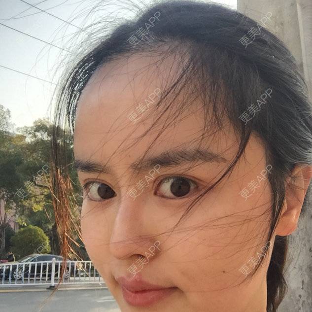 更美 - 15*******85的经验 | 美购日记 | 眉毛种植 | 南昌 | 毛发移植