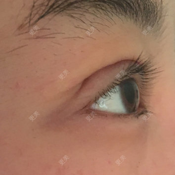 做完全切双眼皮十四天眼尾还是有开叉双眼皮的线条也不对是不是需要