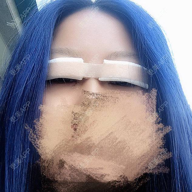 更美 - -  -  -  —  — —的双眼皮经验 | 双眼皮 | 美购日记 | 眼部吸脂 | 开眼角 | 定点双眼皮 | 北京