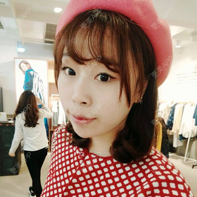 更美 - 啊萌萌萌萌萌的玻尿酸鼻部经验 | 晒对比照 | 玻尿酸鼻部 | 镇江