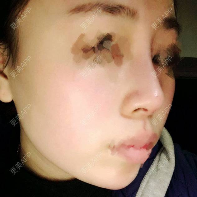 更美 - 啊萌萌萌萌萌的玻尿酸鼻部经验 | 晒对比照 | 玻尿酸鼻部 | 镇江