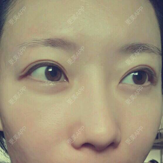 更美 - 清风起舞Winnie的准分子激光原位角膜磨镶术经验 | 准分子激光原位角膜磨镶术 | 美购日记 | 北京