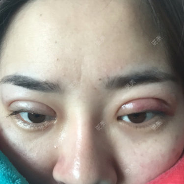 埋线双眼皮第二天怎么肿这么厉害