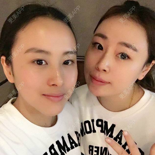 更美 - 啊萌萌萌萌萌的玻尿酸鼻部经验 | 镇江 | 玻尿酸鼻部