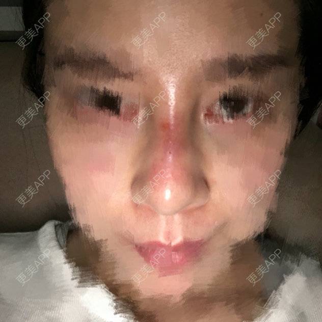 更美 - 豆浆油条来一份的玻尿酸经验 | 西安 | 注射隆鼻 | 玻尿酸