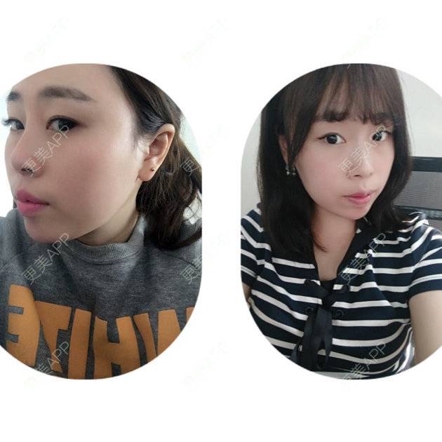 更美 - 啊萌萌萌萌萌的玻尿酸鼻部经验 | 镇江 | 玻尿酸鼻部