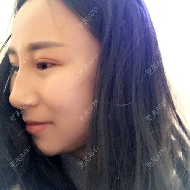 更美 - 安妮🍒的经验 | 自体脂肪隆鼻