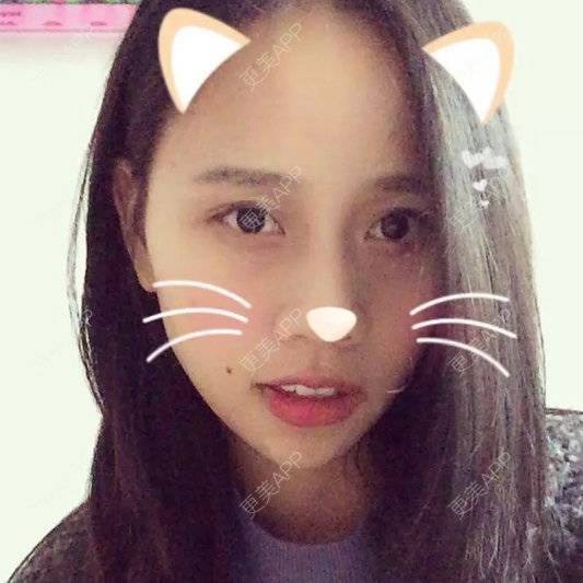 更美 - 猪脑子的激光点痣经验 | 激光点痣 | 重庆