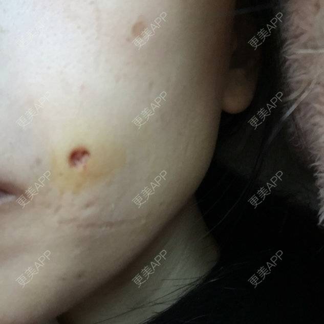 更美 - 猪脑子的激光点痣经验 | 激光点痣 | 重庆