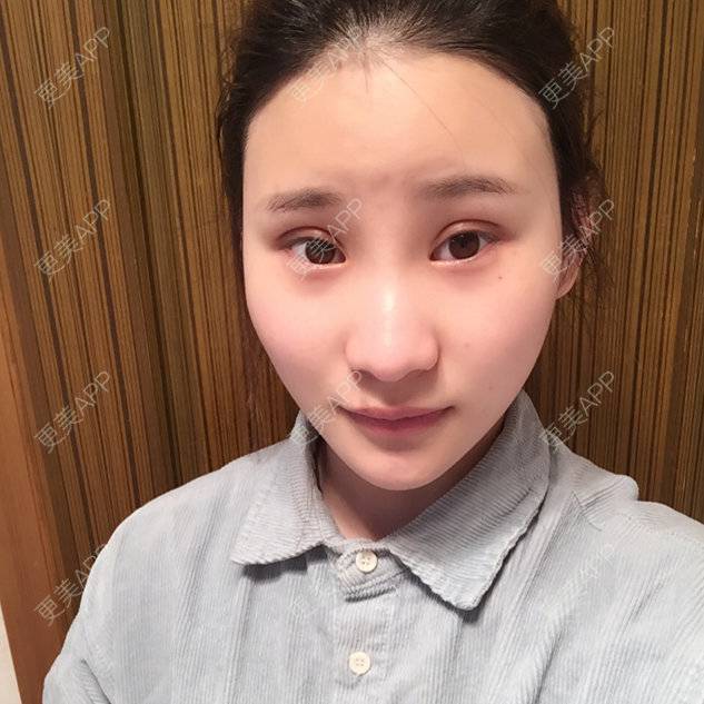 更美 - 来治猩猩的你i的全切双眼皮经验 | 晒对比照 | 全切双眼皮 | 绍兴