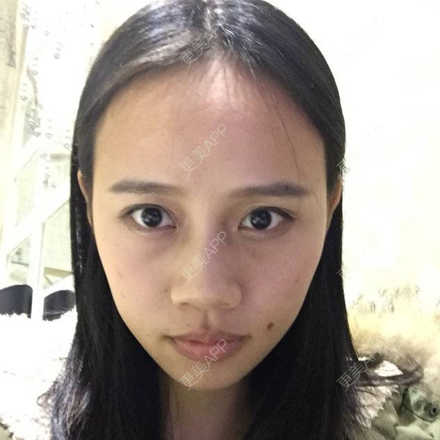 更美 - 猪脑子的激光点痣经验 | 激光点痣 | 重庆