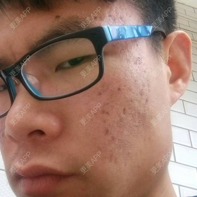 sowhat123的祛疤痕痘印日记