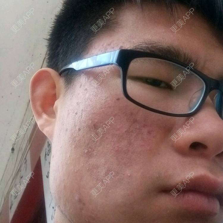 sowhat123的祛疤痕痘印日记