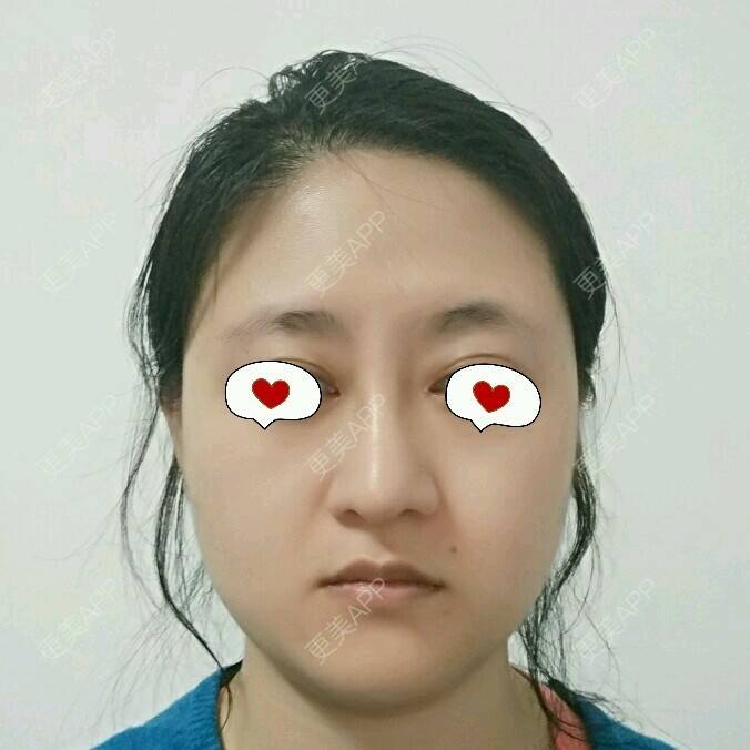 朝天鼻矫正整形_还是banbudian我啊朝天鼻矫正整形_术后42天__更美