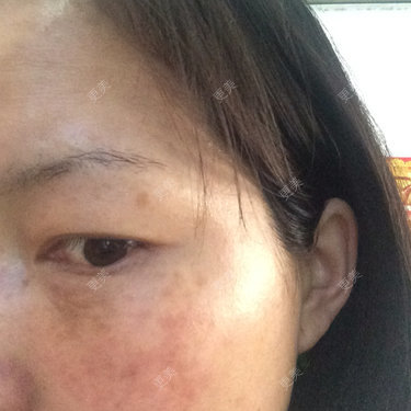 31岁不知什么原因皮肤越来越差做了眼袋后眼睛下面像长了黑色素眼袋虽