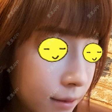 更美 - 王春燕 医生的定点双眼皮经验 | 北京 | 定点双眼皮