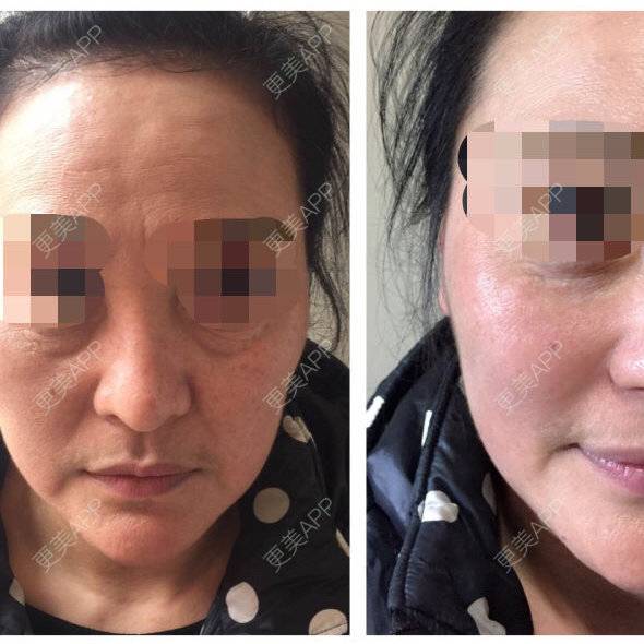 更美 - 啊萌萌萌萌萌的玻尿酸鼻部经验 | 镇江 | 玻尿酸鼻部