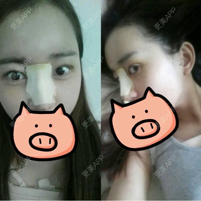 更美 - 王春燕 医生的开内眼角经验 | 北京 | 开内眼角