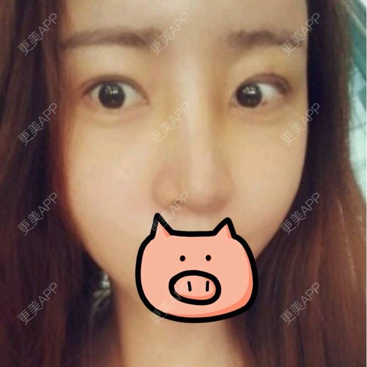 更美 - 王春燕 医生的开内眼角经验 | 北京 | 开内眼角