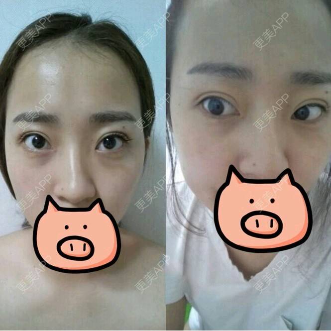 更美 - 王春燕 医生的开内眼角经验 | 北京 | 开内眼角