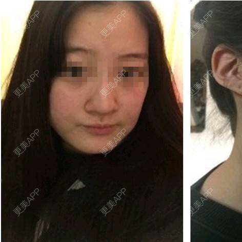 更美 - 王春燕 医生的定点双眼皮经验 | 北京 | 定点双眼皮