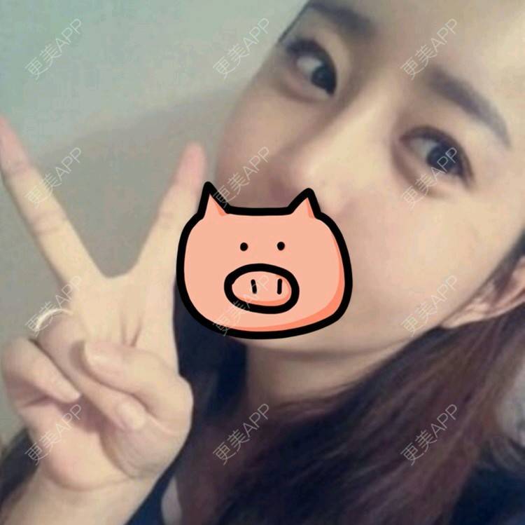 更美 - 王春燕 医生的开内眼角经验 | 北京 | 开内眼角