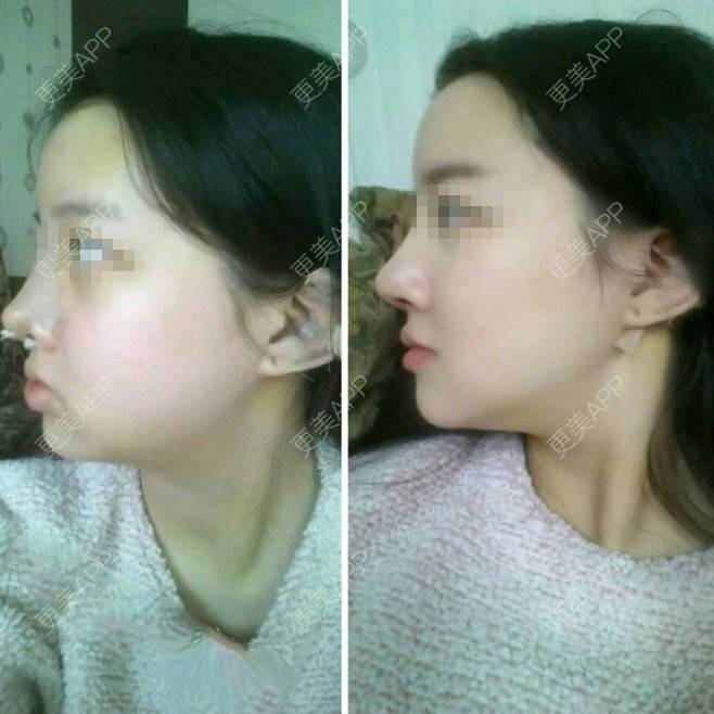 更美 - 王春燕 医生的定点双眼皮经验 | 北京 | 定点双眼皮
