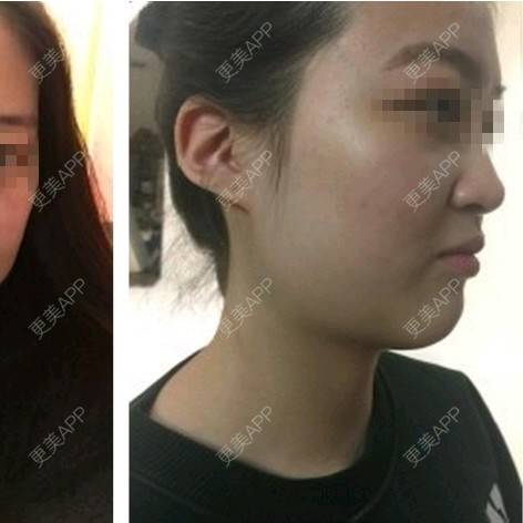 更美 - 王春燕 医生的定点双眼皮经验 | 北京 | 定点双眼皮