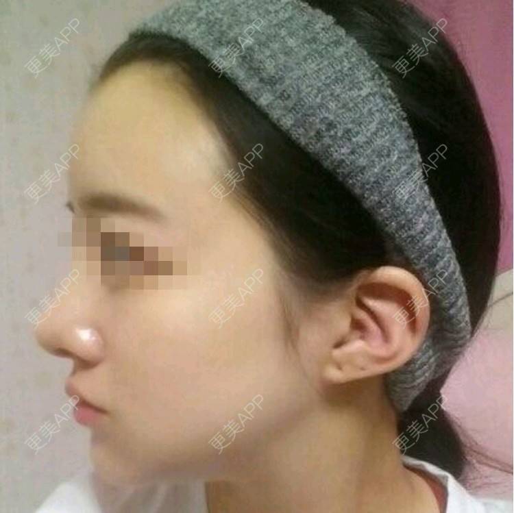 更美 - 王春燕 医生的定点双眼皮经验 | 北京 | 定点双眼皮