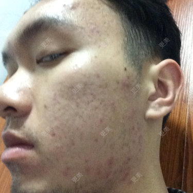 点阵激光