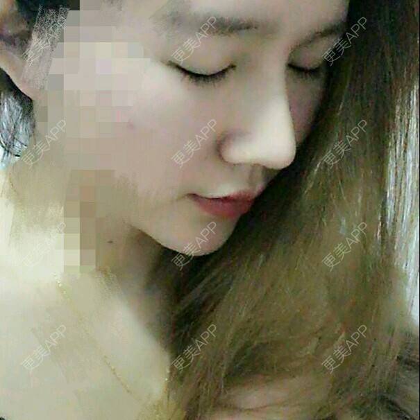 更美 - 心心念念心的经验 | 鼻翼软骨缩合 | 耳软骨隆鼻 | 美购日记 | 鼻部多项 | 广州