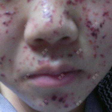 点阵激光