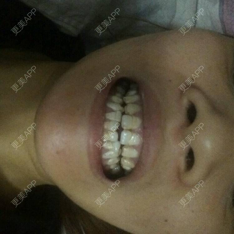 更美 - 更美用户8cu38i3Q3u的经验 | 补牙