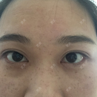 点阵激光