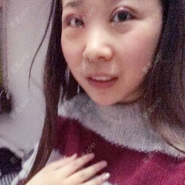 更美 - Black.的双眼皮经验 | 美购日记 | 双眼皮 | 淄博