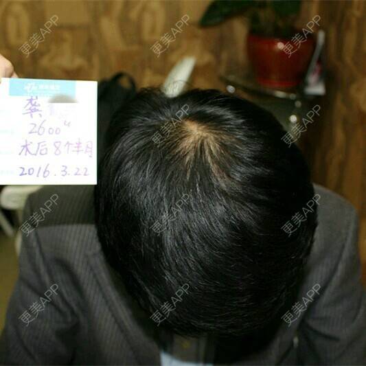 更美 - 刺默的经验 | 植发其他项目 | 上海