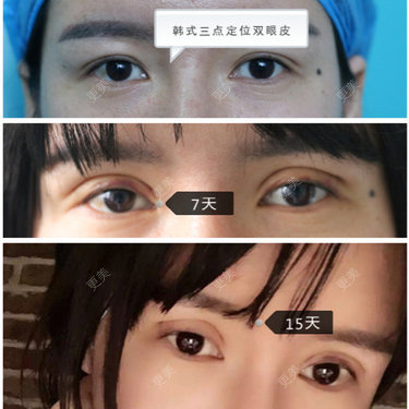 眼部整形