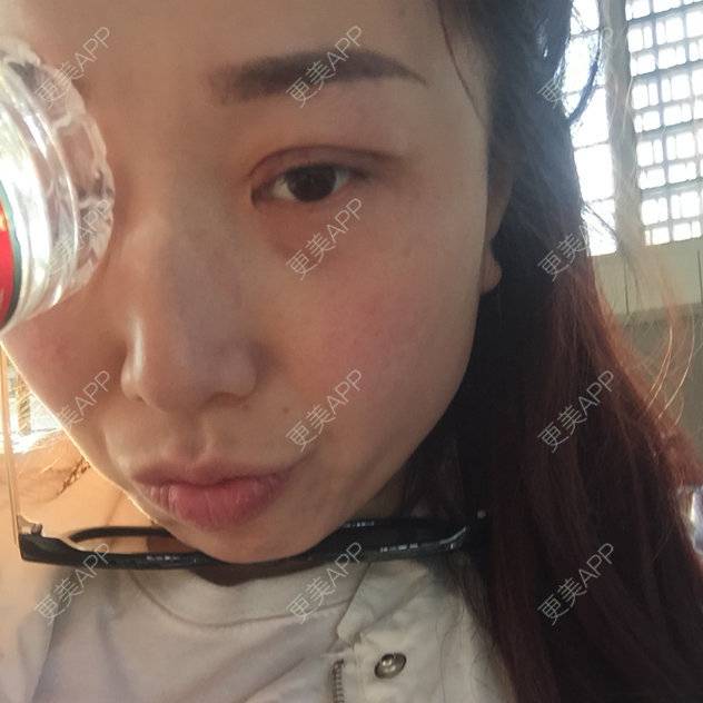 更美 - 更美用户3528653394的埋线双眼皮经验 | 眼部整形 | 长治 | 埋线双眼皮 | 韩式双眼皮术