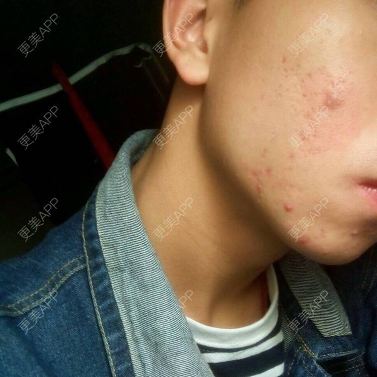 更美 - 土皓的经验 | 点阵激光 | 重庆