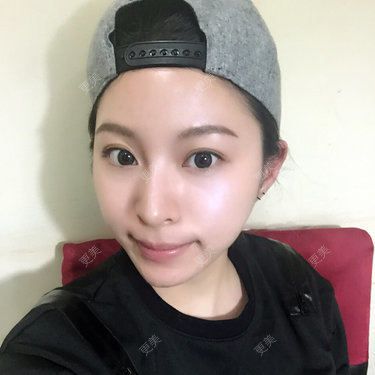 玻尿酸手术 恢复 过程 桃桃萌萌哒整形分享 更美