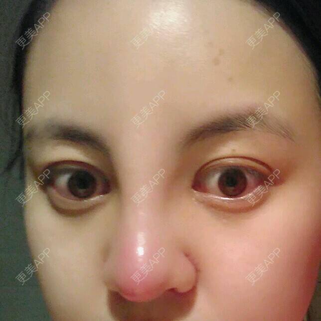 路人一枚的手术缩鼻头日记